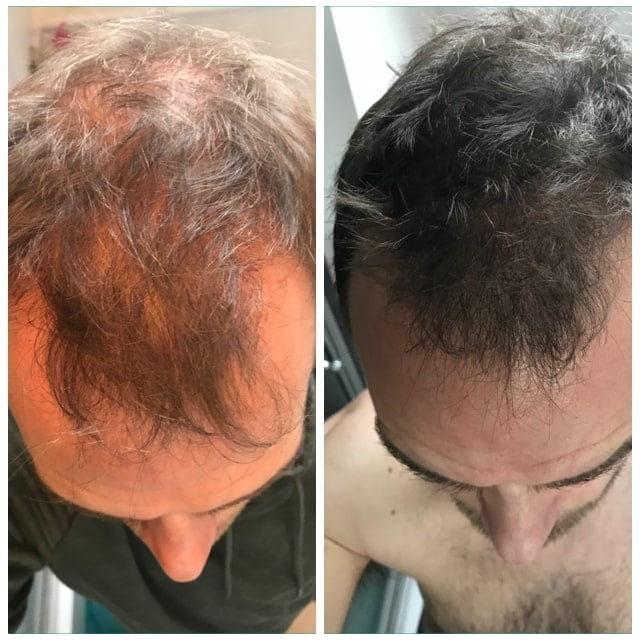 PRP For Male Pattern Baldness 2